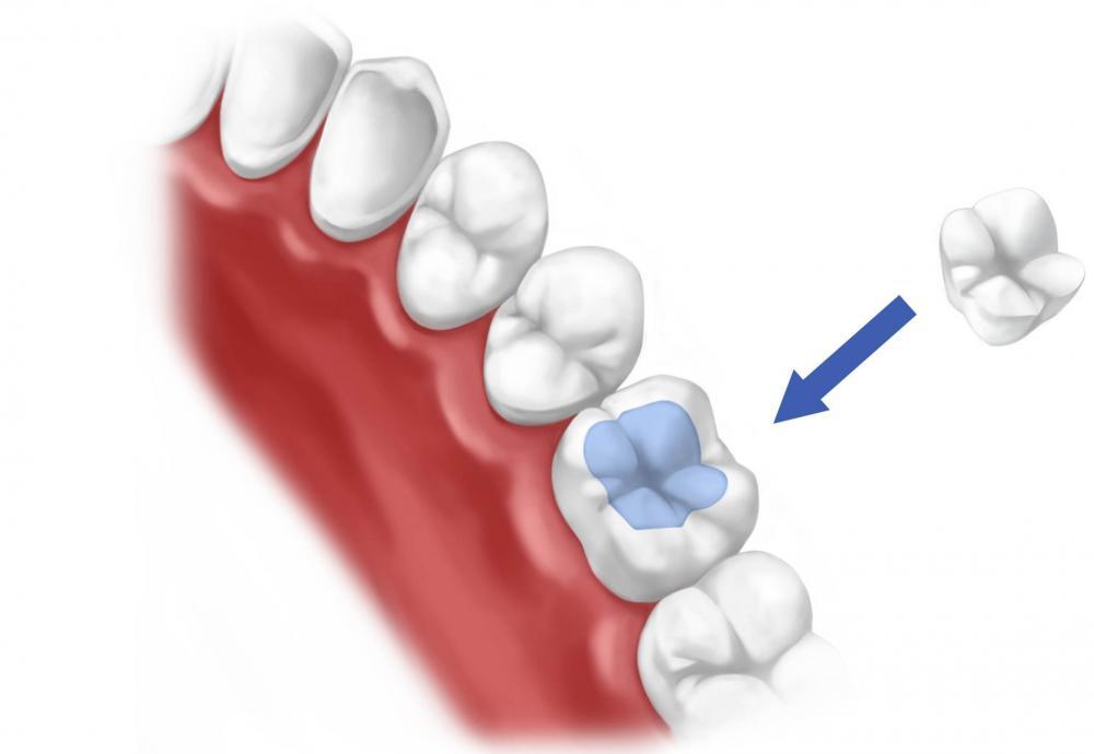 Керамические вкладки при реставрации зуба